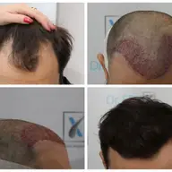 Investește în propria imagine. Clinica Dr. Felix Hair Implant îți va reda încrederea în sine