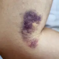 Kelapher, gelul care accelerează vindecarea pielii după traumatisme și intervenții