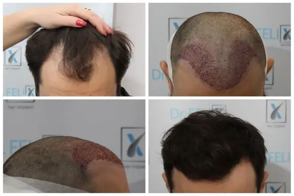 Investește în propria imagine. Clinica Dr. Felix Hair Implant îți va reda încrederea în sine