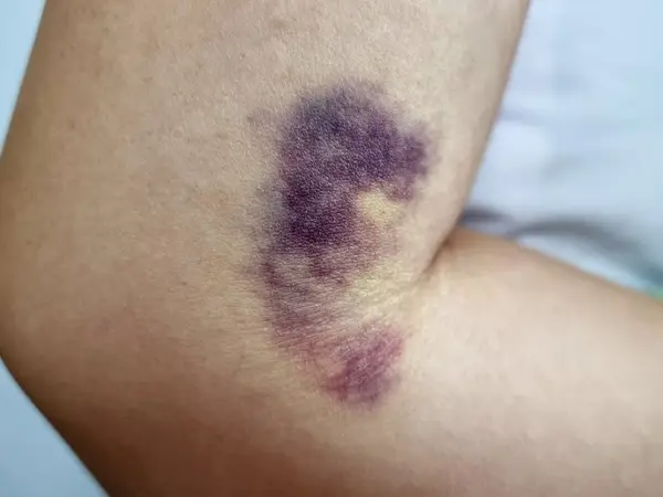 Kelapher, gelul care accelerează vindecarea pielii după traumatisme și intervenții